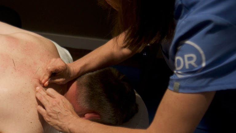 Acupuncture/Dry Needling
