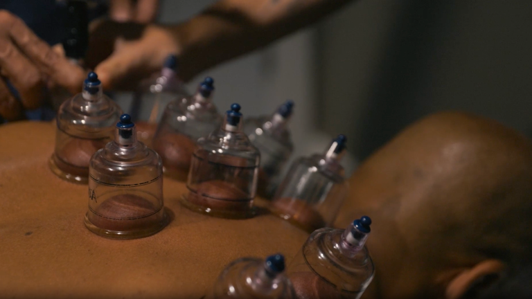 Cupping