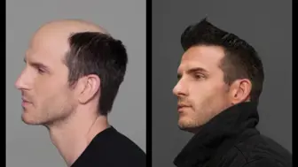 Hair Replacement - Recurring Revenue - Southern California