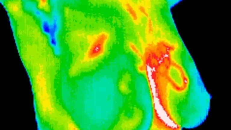 Invasive Ductal Carcinoma